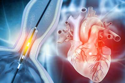 Balloon Angioplasty