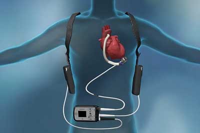 Left Ventricular Assist Device