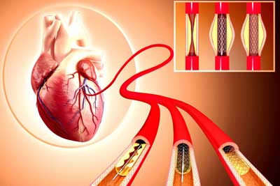 Stent Placement