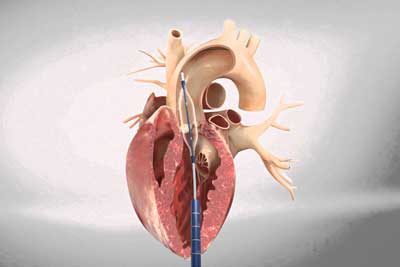 Aortic Valve Replacement
