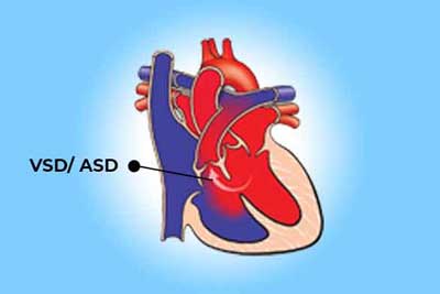 Hole in Heart Closure
