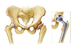 Hip replacement surgery in India