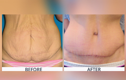 Abdominoplasty Treatment Cost