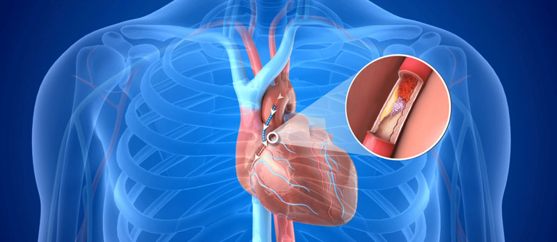 Treatment Illustration